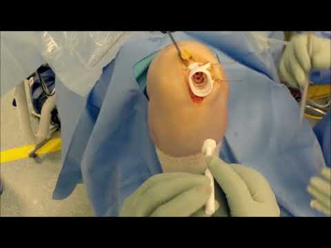 Episealer Twin Right Medial Femora